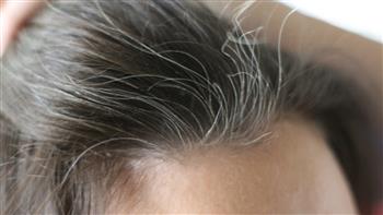   فوائد مذهلة للزنجبيل في علاج الشعر الأبيض