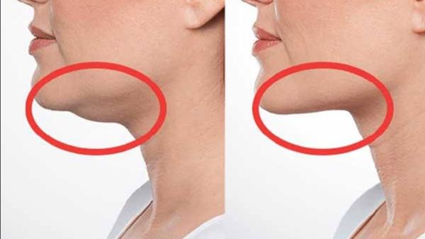 نصائح هامة يجب اتباعها قبل وبعد إجراء شفط الذقن