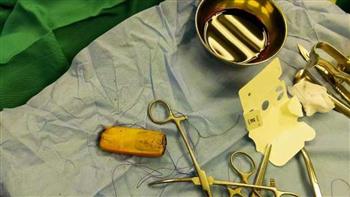   استخراج «هاتف محمول» من معدة مريض في مستشفى أسوان الجامعي