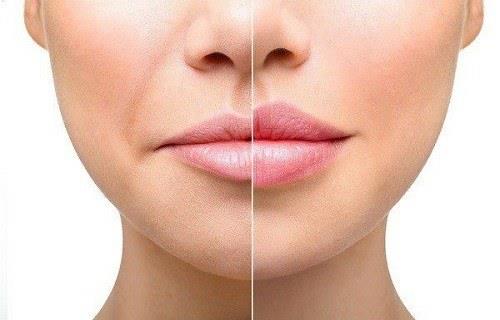 أسرار حول تجميل الشفايف بالليزر