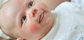   كيف نحمي الأطفال من «حساسية البيض»