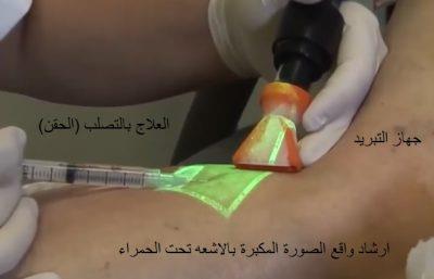 تقنية الكلاكس الأحدث في علاج الدوالي