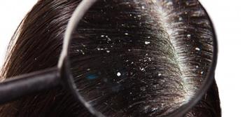   طرق علاج القشرة إحدى مسببات تساقط الشعر