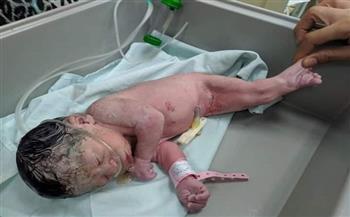   نادرة الحدوث.. ولادة طفل بدون كلى وأعضاء تناسلية مثل عروس البحر بالإسكندرية|| صور