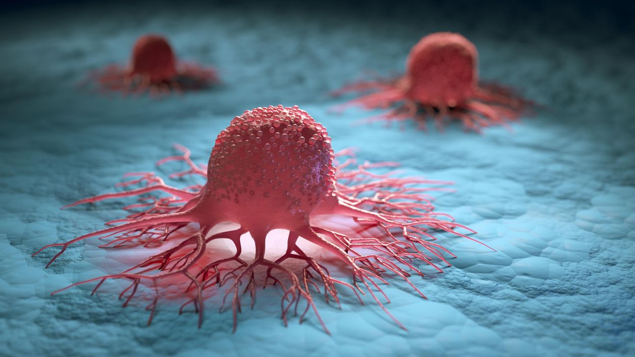 تقنية جديدة توقف انتشار الخلايا السرطانية وتنفذ حياة 90%من المرضى