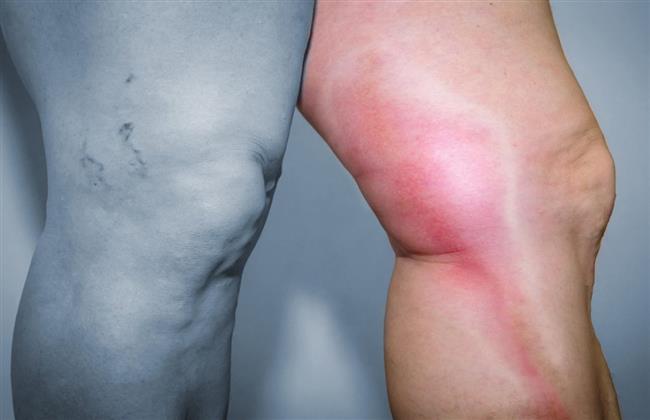  أستاذ جراحات الأوعية يوضح أعراض الجلطة في الرجل