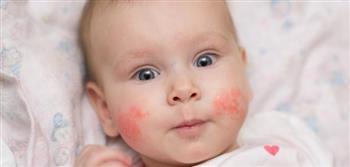 تعرف على أعراض حساسية البيض عند الاطفال
