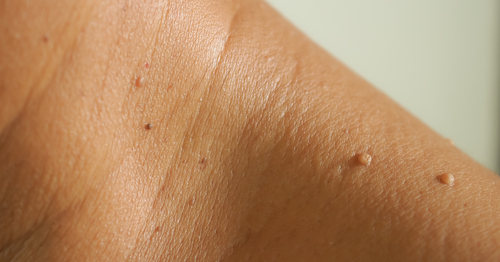 ﻿﻿﻿﻿﻿﻿﻿علاج الزوائد الجلدية بطريقة سهلة