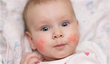   تعرّف على أعراض حساسية الصوف عند الأطفال