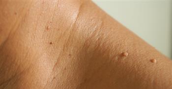   ﻿﻿﻿﻿﻿﻿﻿﻿علاج الزوائد الجلدية بطريقة سهلة