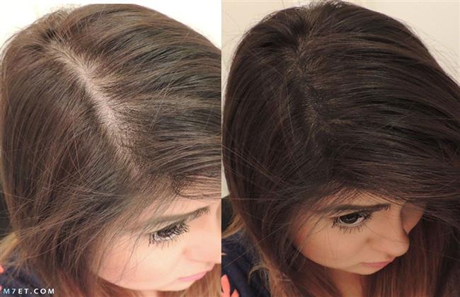 أبرز أسباب لوجود فرغات فى شعر الأطفال