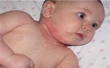   ما الفرق بين جفاف الجلد والاكزيما عند الاطفال