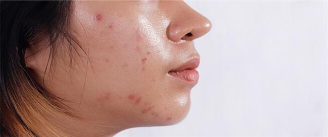 5  أعشاب وخضروات طبيعية للبشره الدهنية 