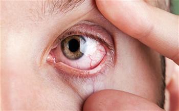   التشخيص المبكر لأورام العيون.. خطوة هامة