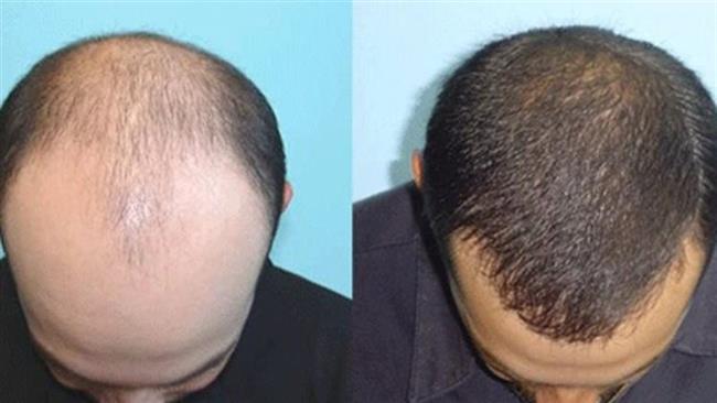 بتطوير شعرة في مختبر.. علماء يتوصلون لابتكار لحل محتمل لمشكلة الصلع 