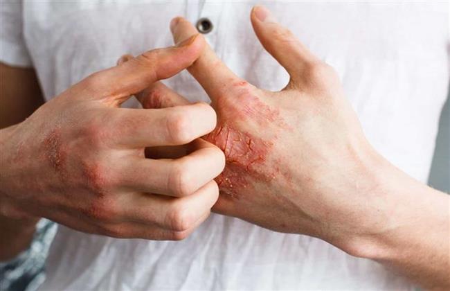 علامات تدل على مقاومة الأنسولين عند النساء