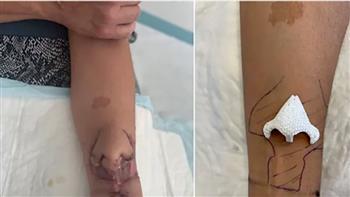 فرنسا.. نجاح عملية زرع أنف على وجه امرأة بعد أن نُمِّي على يدها