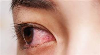   علماء بريطانيون على بعد خطوة واحدة من علاج أكثر أمراض العين المسببة للعمى شيوعًا