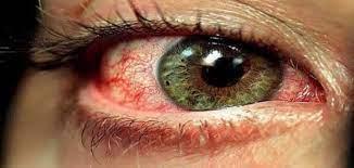  خطوة واحدة.. علاج أمراض العين المسببة للعمى قريبا