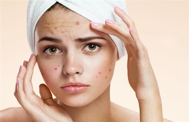 4 وصفات طبيعية لعلاج حب الشباب ..تعرفى عليها 