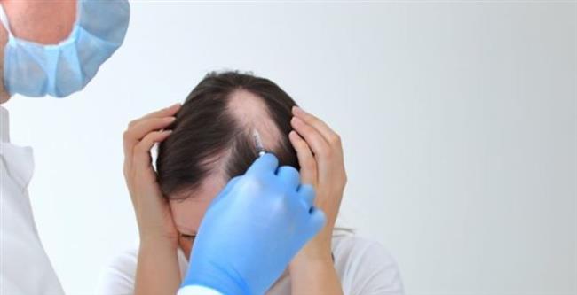 أدوية جديدة لعلاج الثعلبة 