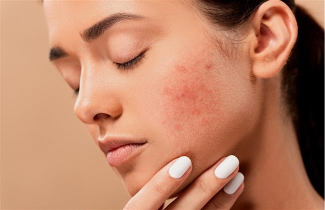 أسباب ظهور البثور وحب الشباب على البشرة