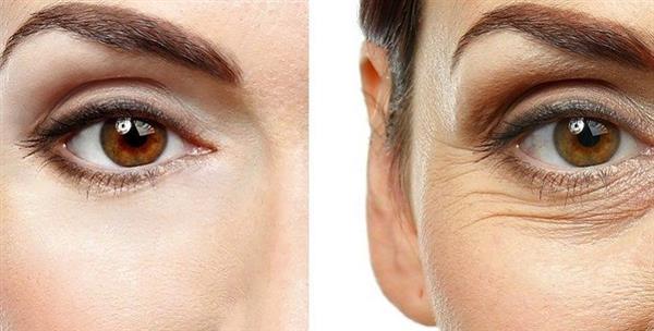 علاجات طبيعية لمشكلة ترهل الجلد حول العين