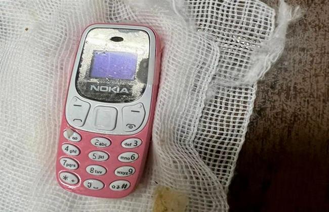 «ابتلعه منذ شهرين».. استخراج هاتف محمول من معدة شاب مصرى.. صور