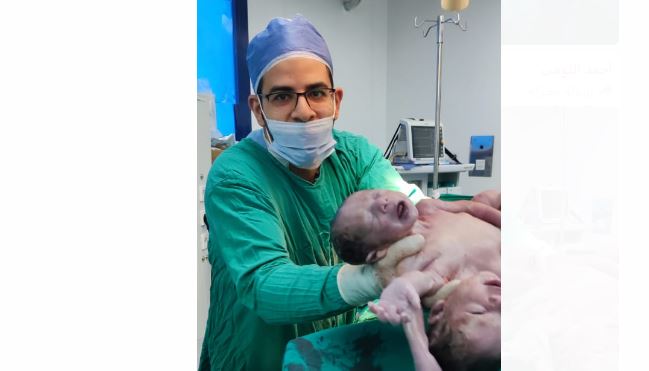 نجاح ولادة توأم ملتصق بمستشفى جامعة المنصورة