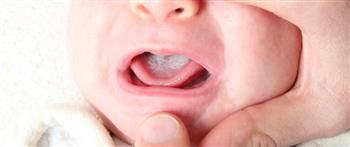   طرق طبيعية لعلاج فطريات الفم عند الرضيع