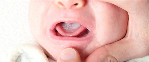 طرق طبيعية لعلاج فطريات الفم عند الرضيع