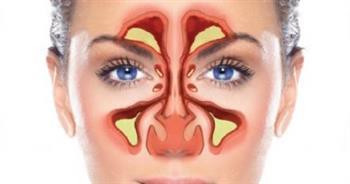 عدوى الجيوب الأنفية.. تعرف على 5 علاجات منزلية فعالة