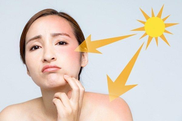 علاجات منزلية بسيطة لحروق الشمس