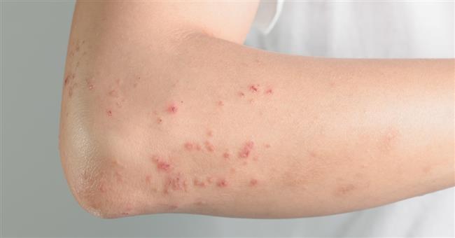 تعرفِ على أعراض حساسية القطط