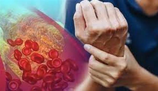 تعرف على أعراض ارتفاع الكوليسترول بالدم
