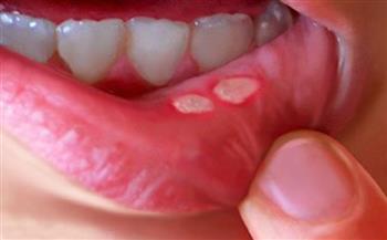   طرق بسيطة لعلاج تقرحات الفم