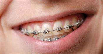   أنواع تقويم الأسنان والحالات التى تحتاجه