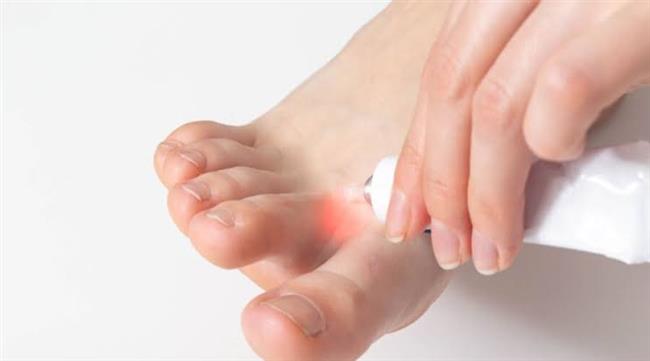 دراسة توضح أنواع الفطريات التي تصيب القدم وأسبابها