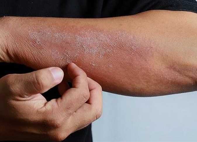 امراض جلدية تدل على الاصابة بأوميكرون