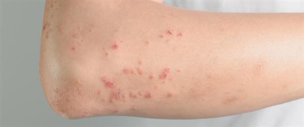 احذر مخاطر فيروس كورونا على الجلد