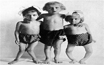 عدم التعرض للشمس يؤدي الي الكساح عند الأطفال
