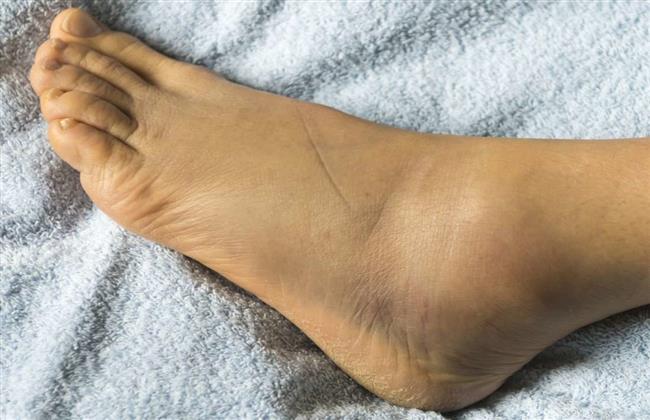 نصائح هامة للوقاية من قرح القدم السكري ومخاطرها
