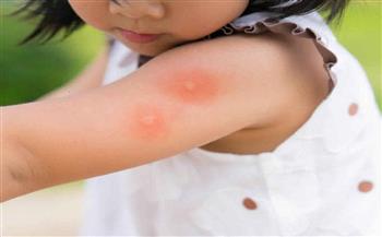   علاج حساسية الصويا عند الأطفال
