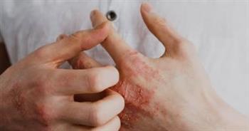 ما هو التهاب النسيج الخلوى وأعراضه المختلفة