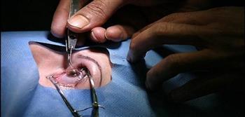 السباعى : عمليات الليزك لا تلائم الجميع بل لابد من فحص حالة المريض 