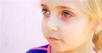   ما أسباب حساسية العين عند الأطفال؟
