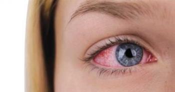   ما أسباب إحمرار العين المستمر وطرق علاجها؟