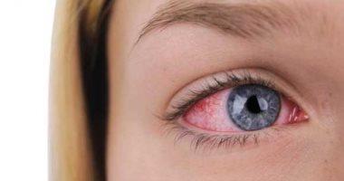 ما أسباب إحمرار العين المستمر وطرق علاجها؟