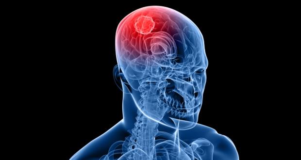 تعرف على أعراض "الإقفارية العابرة" وطرق الوقاية منها