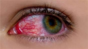   العين تكشف عن ارتفاع ضغط الدم